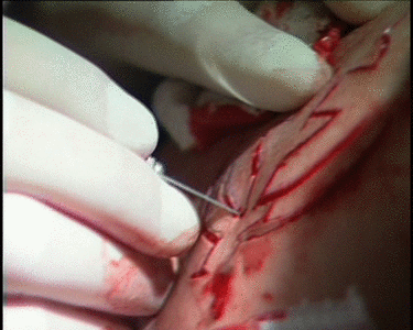 Scarring shoulder during performance