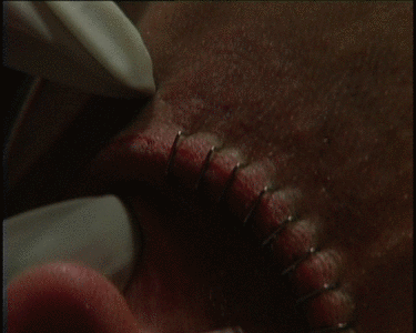 Head staples being inserted